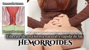 hemorroides-internas