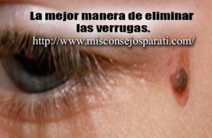 La mejor manera de eliminar  las verrugas.