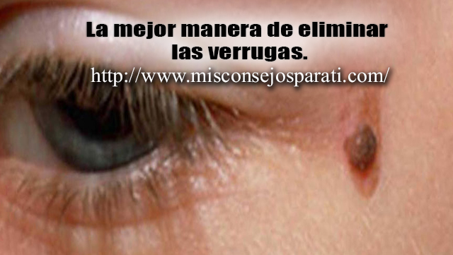 La mejor manera de eliminar  las verrugas.