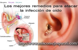 Los mejores remedios para atacar la infección de oído