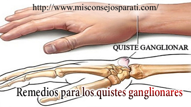 Remedios para los quistes ganglionares