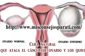 Cura natural  que ataca el cáncer de ovario y los quistes