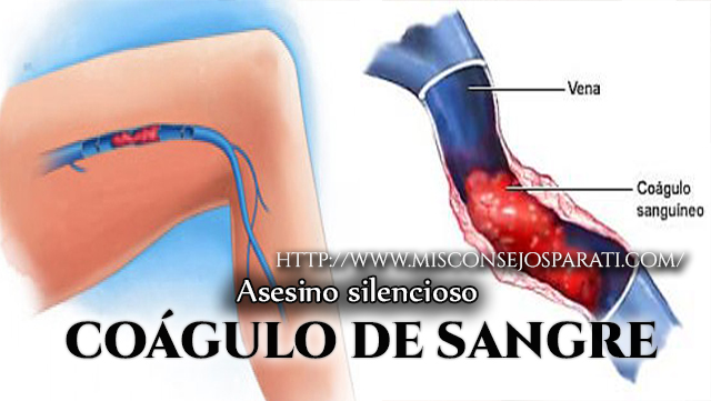 Coágulos de sangre asesino silencioso