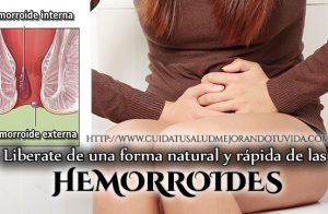 Adiós  hemorroides
