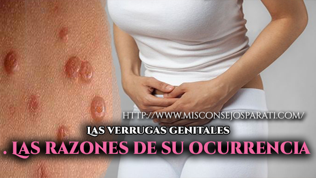 Las verrugas genitales. Las razones de su ocurrencia