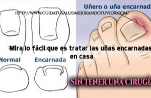 Mira lo fácil que es tratar las uñas encarnadas en casa, sin tener una cirugía