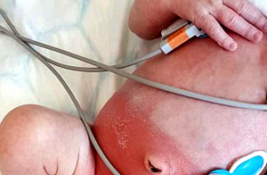 Madre usa popular marca de pañales en su hija, 20 minutos después la niña tiene una reacción por las quemaduras y ampollas causadas por el pañal