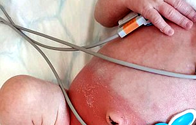 Madre usa popular marca de pañales en su hija, 20 minutos después la niña tiene una reacción por las quemaduras y ampollas causadas por el pañal