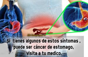 Si  tienes algunos de estos síntomas , puede ser cáncer de estomago, visita a tu medico.