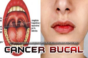 Reconoce a tiempo el cáncer de boca, aquí los síntomas tempranos