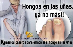 hongos en las uñas.