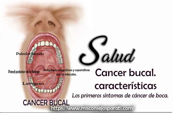 Cáncer de boca, síntomas.